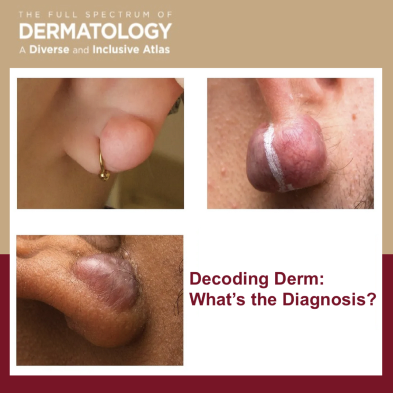 Journal of Drugs in Dermatology JDD About The Full Spectrum of Dermatology: A Diverse and Inclusive Atlas. The images is of keloid among different skin tones